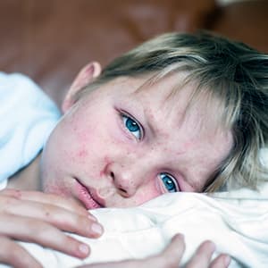 REPLAY: Our chat on everything you need to know about measles