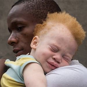 Beyond the pale: Living with albinism in Africa