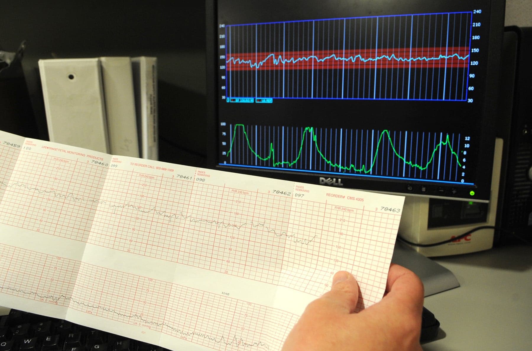 The use of electronic fetal monitoring is expanding into Africa—and that's a problem