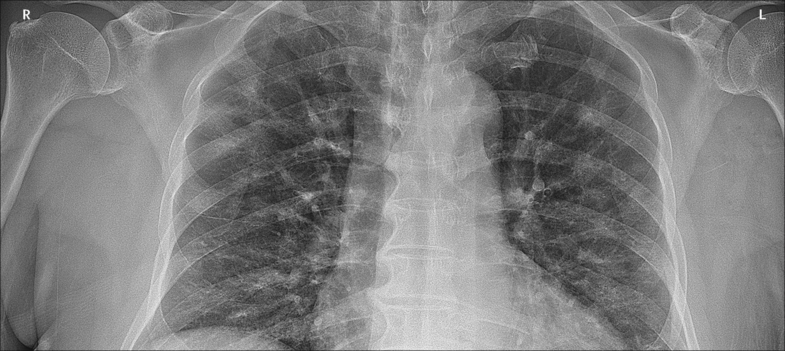 An X-ray that showed diffuse opacities throughout a patient’s lungs led doctors to identify the first known case of COVID-19 in Canada (The Lancet/Elsevier)