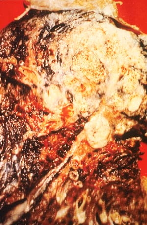 Cancerous lung (Source: National Institutes of Health)