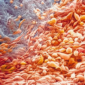 Color enhanced scanning electron micrograph (SEM) of cancer cells. Malignant melanoma of the human iris. (Ralph C. Eagle Jr./Science Source Images)