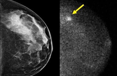 breast_cancer