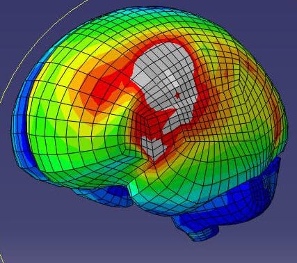 A 3D model of the damage done to Crosby's brain