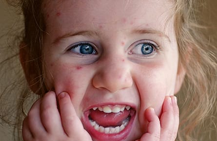 Why do we itch?