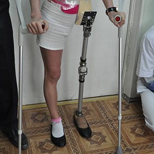 A female-amputee candidate from Donetsk region was also part of Ukraine Prosthetic Assistance Project, who lost her leg as a result of shelling by separatists. Valentina Okhlopkova
